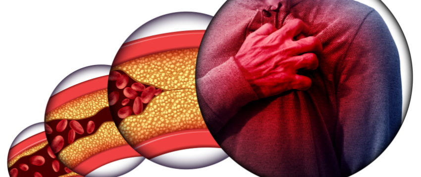 Cardiovascular Disease
